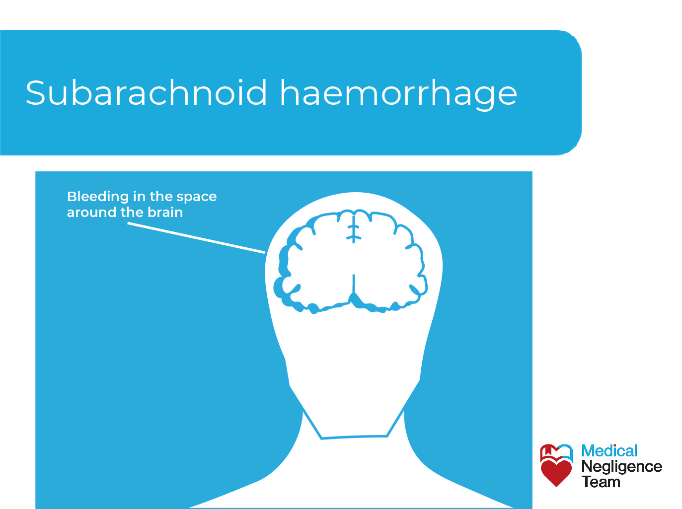 Subarachnoid haemorrhage misdiagnosis claim